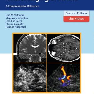 Neurosonology and Neuroimaging of Stroke (A Comprehensive Reference) (2nd Edition)
