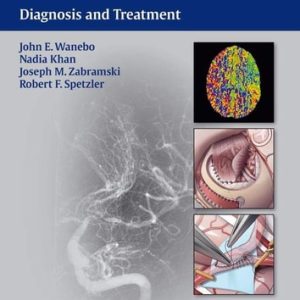 Moyamoya Disease (Diagnosis and Treatment)